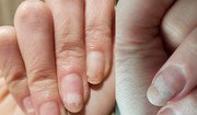  Onycholiza paznokcia - objawy i leczenie choroby