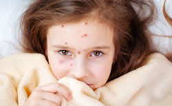 Pediatra: W tym sezonie dużo więcej dzieci z powikłaniami ospy