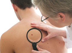 Rak skóry zbiera tragiczne żniwo. Poznaj czerniaka