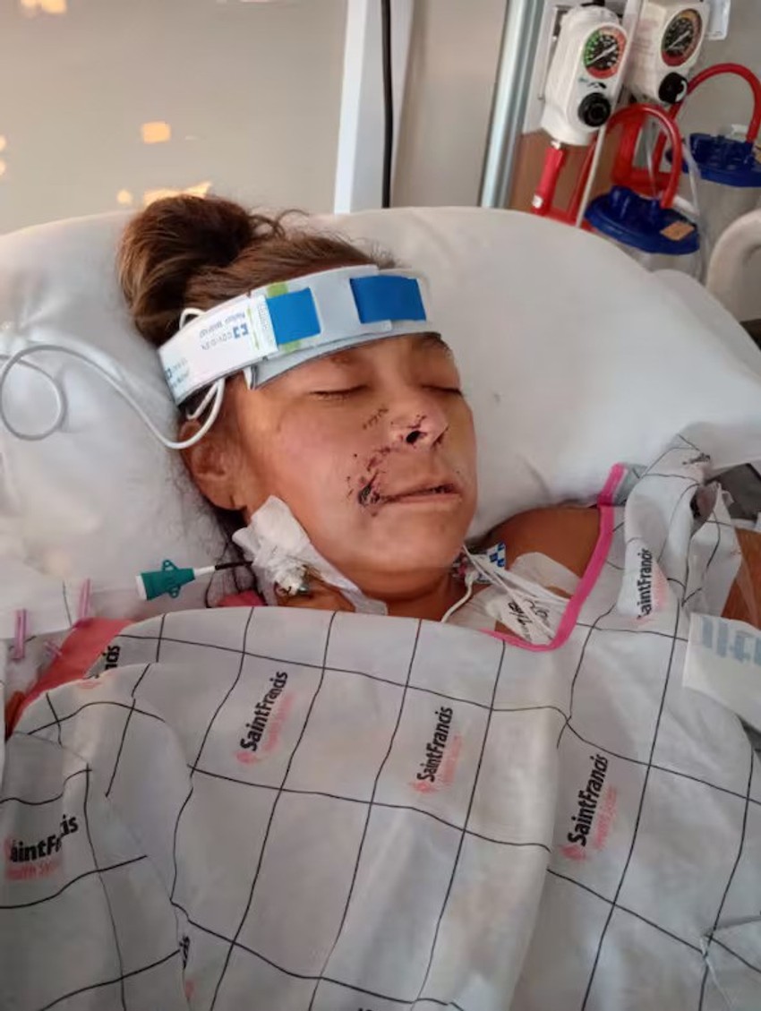 Žena kojoj su odsečene ruke i noge zbog napada pitbula