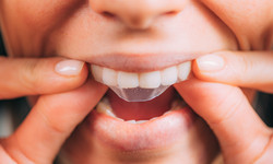 Czy paski wybielające zęby są skuteczne? Dentystka mówi wprost