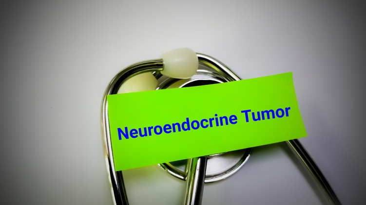 Neuroendokrin daganatok