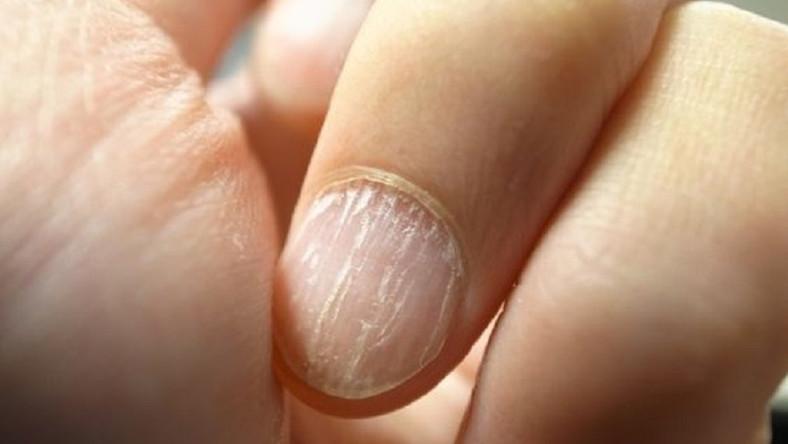 hogyan értik, hogy a köröm gomba nail gombák tünet kezelés