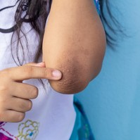 Kinél és miért  alakul ki a scleroderma?