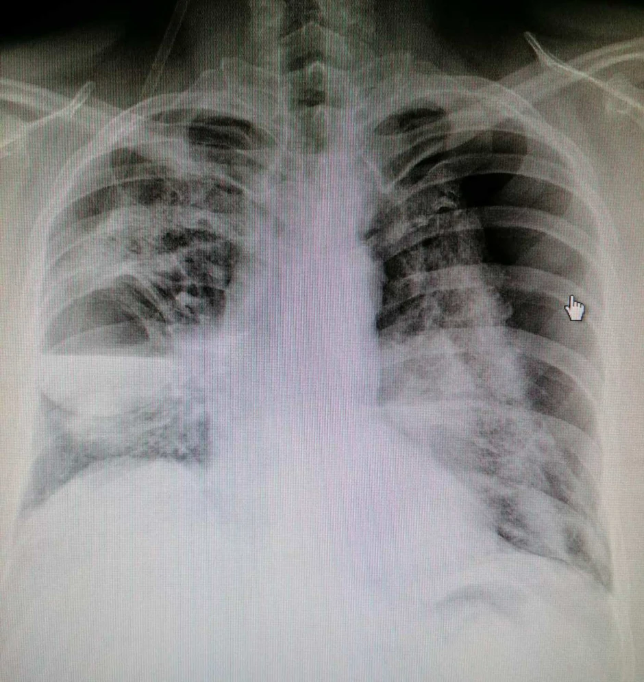 Snimak pluća nakon obostrane drenaže