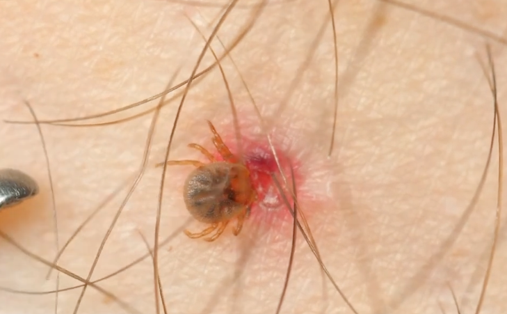 Austrálsky paralytický kliešť (Ixodes holocyclus), ktorého sliny obsahujú neurotoxíny schopné vyvolať svalovú paralýzu.
