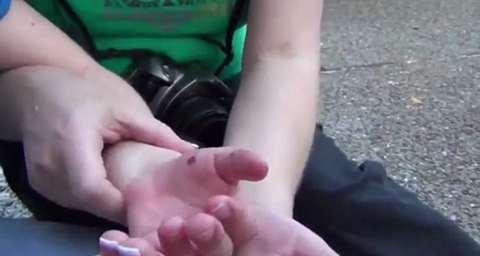 Povrede na rukama devojčice posle napada