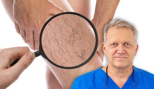 Ljudi očekuju da prvo vide velike plave vene, međutim, često sve počinje mnogo diskretnije, objašnjava vaskularni hirurg dr Dario Jocić