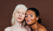 Bielactwo - przyczyny i objawy albinizmu. Czy bielactwo można wyleczyć?