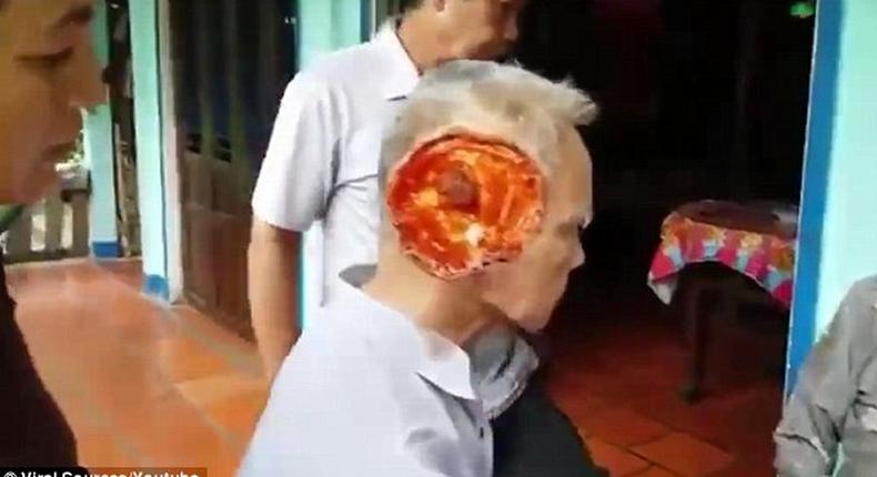 Mysterious flesh-eating virus eats away the whole of man’s face [Graphic]