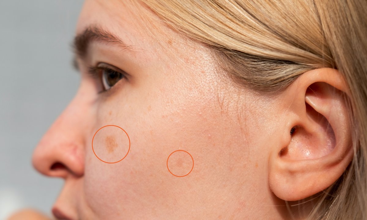 To luksusowe serum gwałtownie rozgramia plamki starcze. Precyzyjne jak laser!