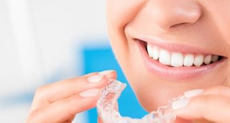 Jak działa aparat ortodontyczny Invisalign