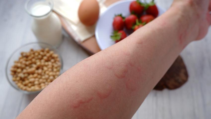 csalánkiütés bőrbetegségek allergia diéta autoimmun betegség bőrbetegség