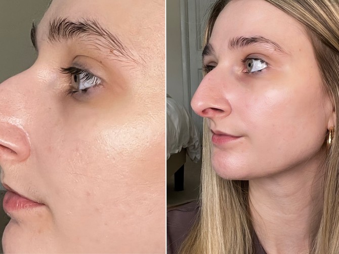 Influenserka Devin Ejken pre operacije