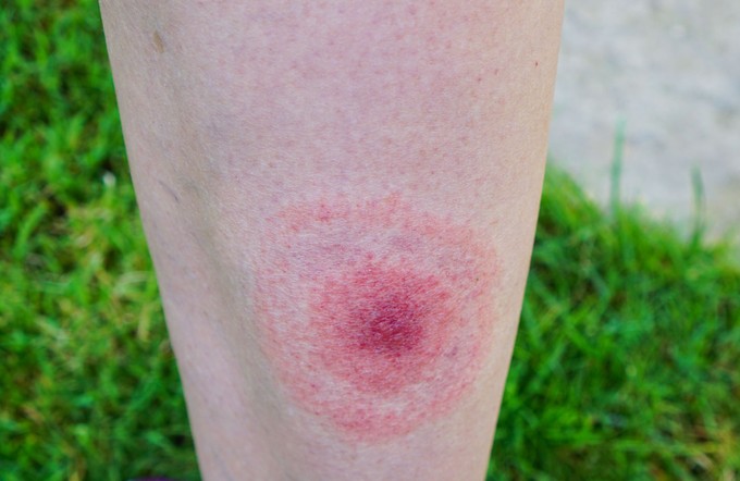 Hogy néz ki a Lyme-folt? Mikor jelenik meg, és vajon mindig látható?