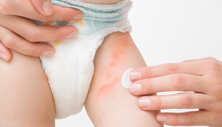 Diaper rash (irritant diaper dermatitis)