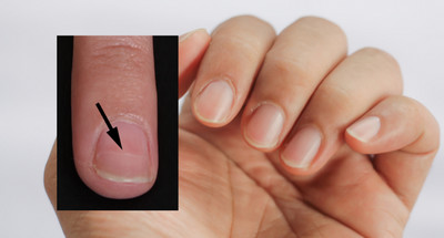Linie Beau na paznokciach— co oznaczają, jak je zdiagnozować i leczyć?