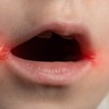 Impetigo na licu najpre počinje oko usta i nosa