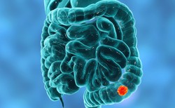 RAK JELITA GRUBEGO długo rozwija się w ukryciu. Najczęstsze objawy