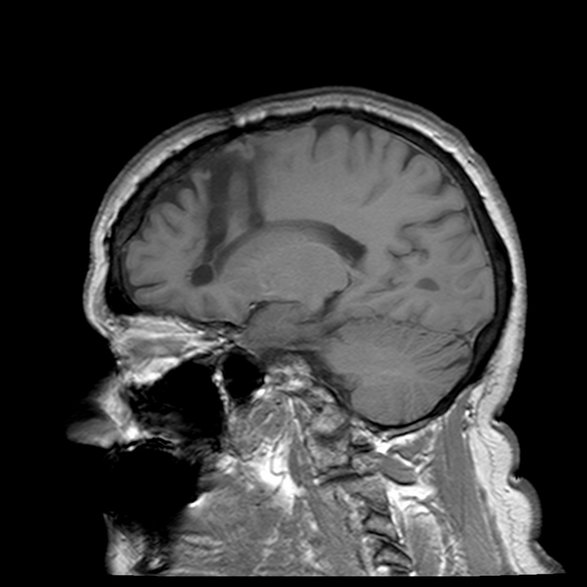 Rezonans magnetyczny czaszki pacjenta, u którego wykonano kilkadziesiąt lat wcześniej lobotomię.