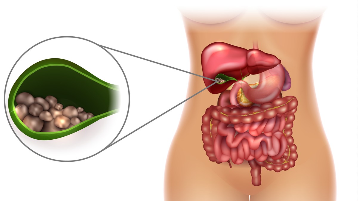 Porcelanska žučna kesa: Kako ovaj organ postaje skamenjen i zašto može da bude uvod u rak