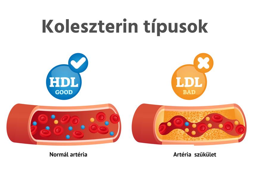 Hiperkoleszterinémia (magas koleszterinszint) tünetei és kezelése