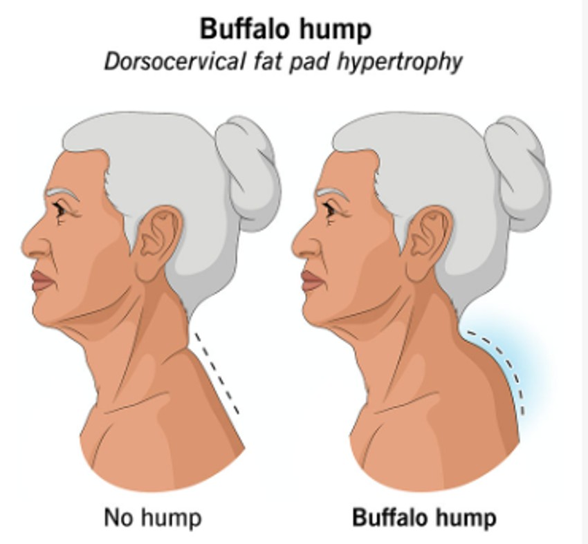 Usled bivolje grbe je zaobljen zadnji deo vrata, obično u području između lopatica