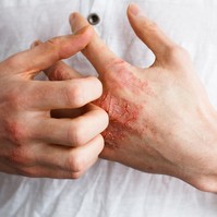 Krónikus viszketés: ezek a sejtek okozhatják a vakarózási ingert az ekcémánál