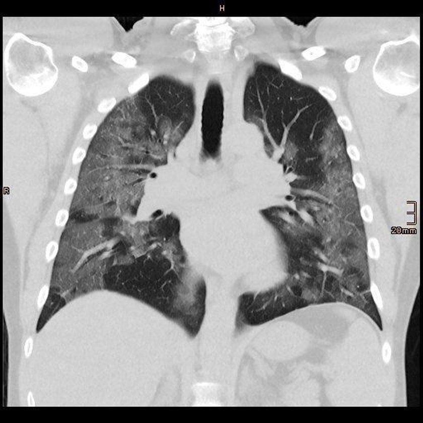 Koronawirus: respiratory niezbędne w zwalczaniu COVID-19?