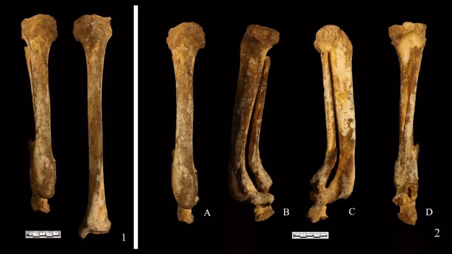 Analiza kości wykazała, że stopa kobiety została brutalnie odcięta, fot. Li Nan/Acta Anthropologica Sinica