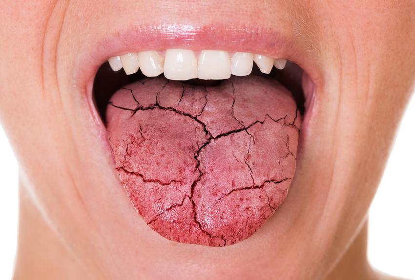Égő száj szindróma: ez a 6 betegség szájszárazsággal jelez | EgészségKalauz