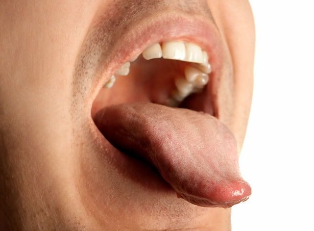 Groźna bakteria z ust wywołuje zapalenie opon mózgowych