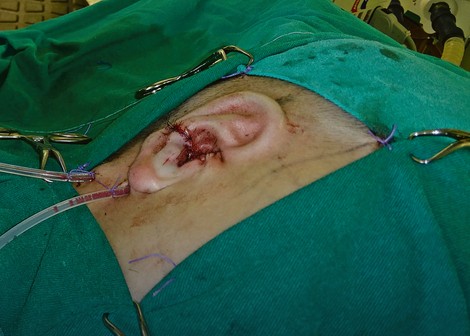 Rezultat hirurškog zahvata
