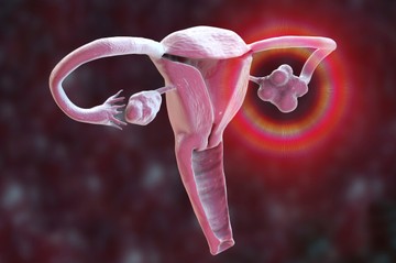Gyakori betegség a nőiesség útjában: a PCOS-szindróma minden tizedik nőt érinti