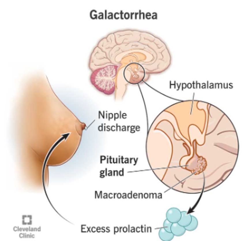 Galaktoreja izaziva curenje mleka iz bradavice, koje nije povezano sa laktacijom