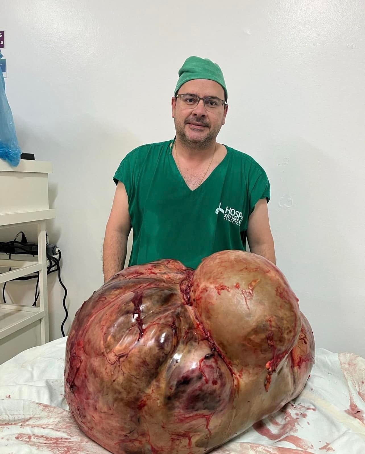 Žene vyoperovali nádor, ktorý vážil neuveriteľných 100 kilogramov. 