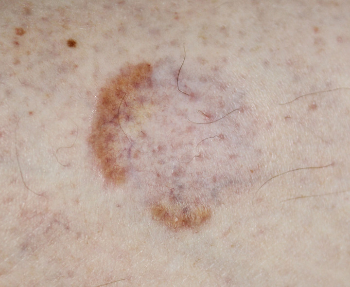 Necrobiosis lipodica / fot. Dermatology11, Shutterstock