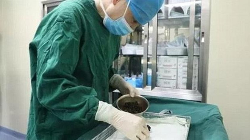 Chirurdzy usunęli 200 kamienic z ciała chinki