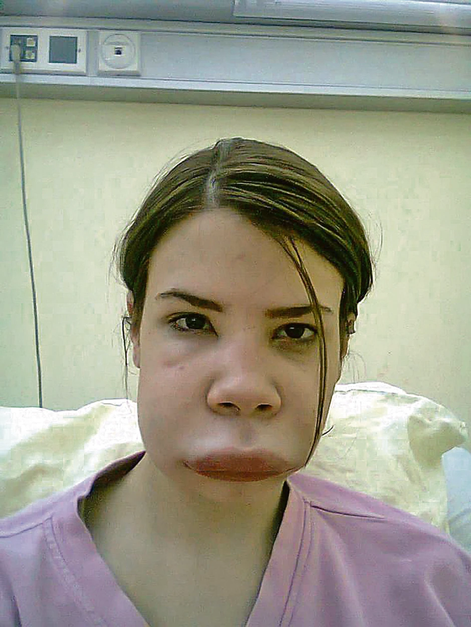 Kada dođe do napada, Jovani se naduje lice, usta, čelo, nos...