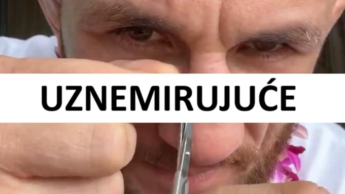 ŠOK I NEVERICA, sve je prenosio uživo: UFC borac skidao sam sebi konce sa lica - NIJE ZA ONE SA SLABIM STOMAKOM! /VIDEO/