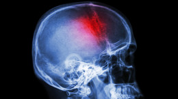 Jak zmniejszyć ryzyko udaru mózgu?