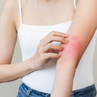 Gyermekek tízezreit érinti Magyarországon – így rontja az életminőséget az atópiás dermatitisz