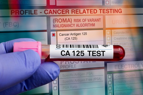 Mit jelent a CA-125 érték a laborleleten?