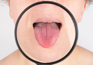 Makroglosija je stanje u kojem je jezik veći nego što je uobičajeno u odnosu na usnu duplju