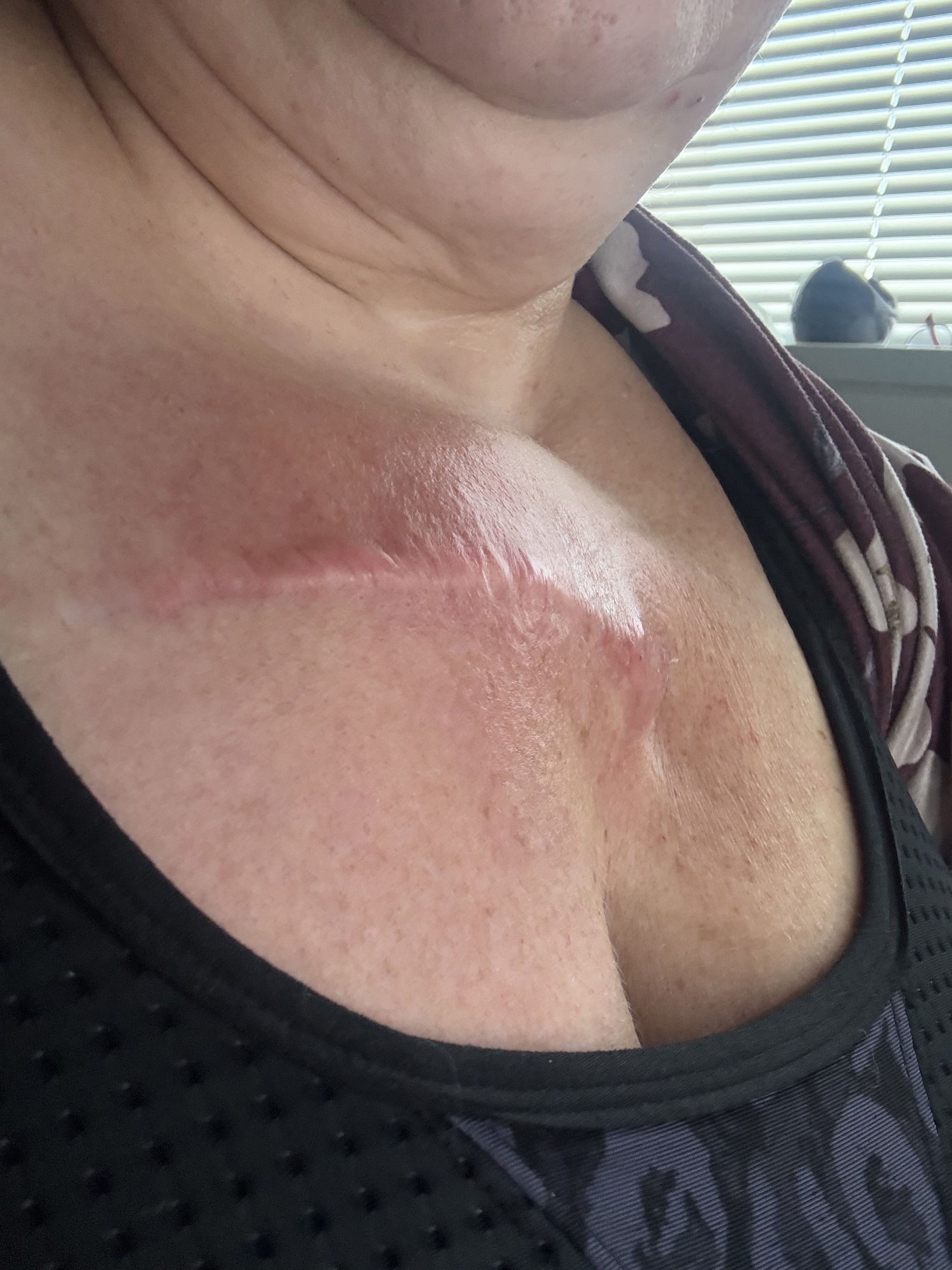 Rebecca Turner bojuje s rakovinou.