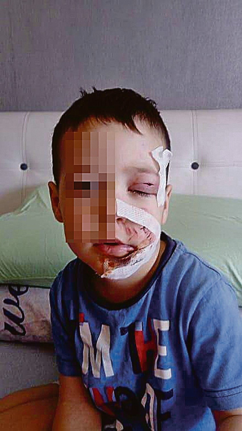 Dečak V. P. igrao se u parku kada je na njega skočio pas i izujedao ga po licu