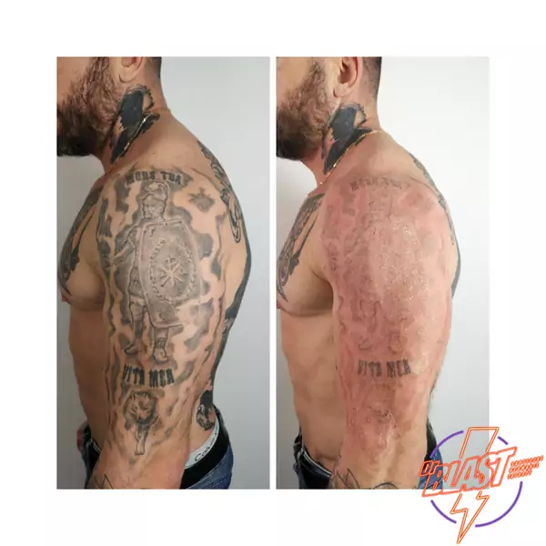 Dr Blast: Usuwanie tatuażu to czasochłonny proces, który wymaga cierpliwości