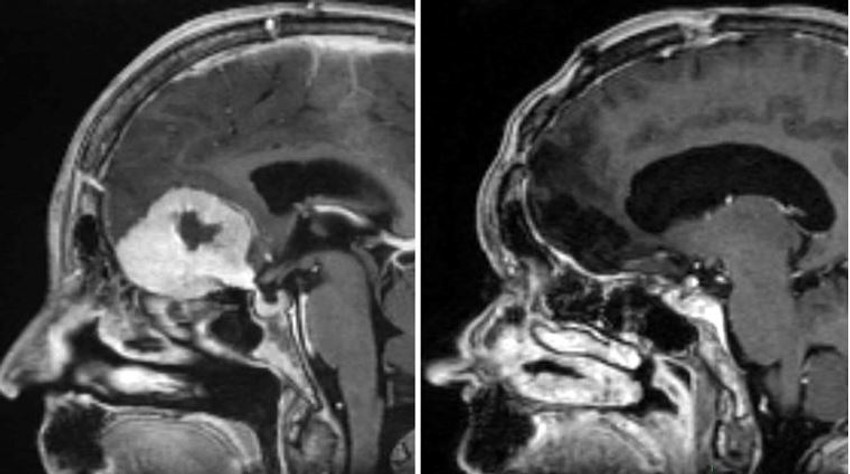 Snimak tumora na mozgu (levo) i nakon uklanjanja (decno)