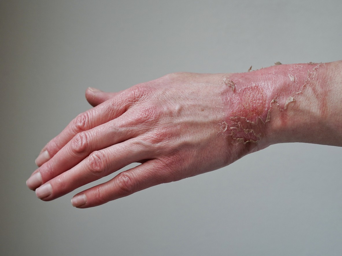 Contact with liquid nitrogen can lead to burns!