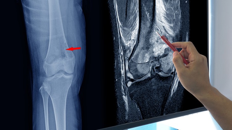 Osteosarcoma